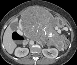Serous Cystadenoma - CTisus CT Scan