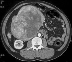 Neurogenic Tumor Simulates A Pancreatic Mass - CTisus CT Scan