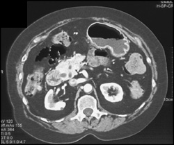 Pancreas Divisium - CTisus CT Scan