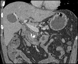 Pancreatic Cancer - CTisus CT Scan