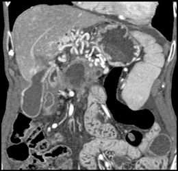 Cavernous Transformation of the Portal Vein (PV) Due to Occlusion By Pancreatic Cancer - CTisus CT Scan