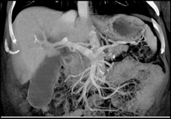 Pancreatic Cancer - CTisus CT Scan