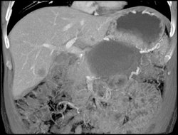 Cystic Lesion Occludes the Splenic Vein - CTisus CT Scan