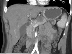 Solid and Papillary Neoplasm of the Pancreas - CTisus CT Scan