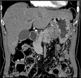 Pancreatic Cancer - CTisus CT Scan