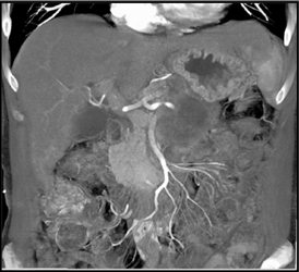 Pancreatic Cancer - CTisus CT Scan