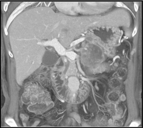Pancreatic Cancer - CTisus CT Scan