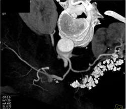 Encased Celiac Artery - CTisus CT Scan