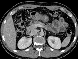 Post Whipple Procedure With Dilated Pancreatic Duct - CTisus CT Scan