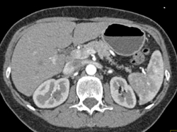 Atrophy of the Tail of the Pancreas - CTisus CT Scan