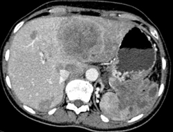 Neuroendocrine Tumor With Liver and Splenic Metastases - CTisus CT Scan