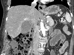 Pancreatic Cancer - CTisus CT Scan