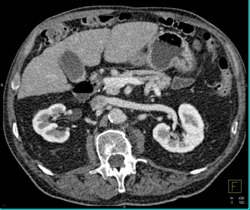 Pancreatic Cancer - CTisus CT Scan