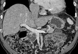 Intraductal Papillary Mucinous Neoplasm (IPMN) - CTisus CT Scan