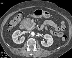 Cystadenoma of the Pancreas - CTisus CT Scan