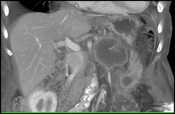 Carcinoma of the Pancreatic Tail Invades the Superior Mesenteric Vein (SMV) - CTisus CT Scan