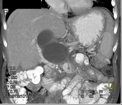 Pancreatic Pseudocyst With Cavernous Transformation of the Portal Vein (CTPV) - CTisus CT Scan