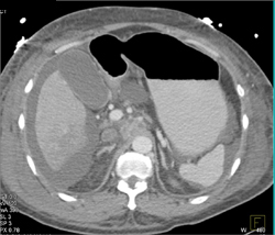 Tumor in Right Lobe Suspicious for Hepatoma - CTisus CT Scan