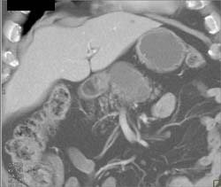 Cystadenoma - CTisus CT Scan