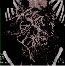 Encasement of PV/SMV With Collaterals - CTisus CT Scan