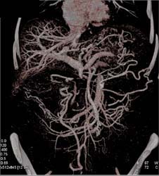 Tumor Encases SMV/PV Confluence - CTisus CT Scan