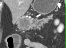 Pancreatic Cancer With Dilated Pancreatic Duct - CTisus CT Scan