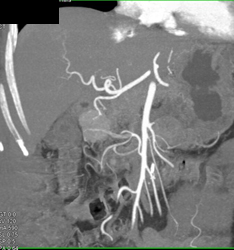 Islet Cell Tumor - CTisus CT Scan