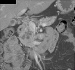 Intraductal Papillary Mucinous Neoplasm (IPMN) - CTisus CT Scan