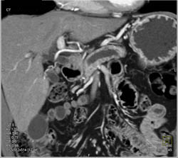 Pancreatic Cancer Obstructs the Pancreatic Duct - CTisus CT Scan