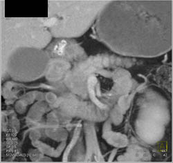 Pancreatic Cancer Encases the PV/SMV - CTisus CT Scan