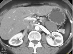 Lymphangioma - CTisus CT Scan