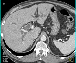 Dilated Common Bile Duct (CBD) and Intrahepatic Duct Due to Pancreatic Cancer - CTisus CT Scan