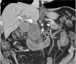 Cystadenoma of Pancreatic Head - CTisus CT Scan