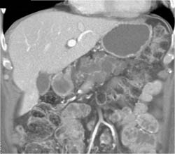 Multiple Intraductal Papillary Mucinous Neoplasms (IPMNs) - CTisus CT Scan