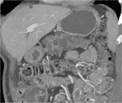 Multiple Intraductal Papillary Mucinous Neoplasms (IPMNs) - CTisus CT Scan