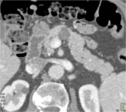 Intraductal Papillary Mucinous Neoplasm (IPMN) - CTisus CT Scan
