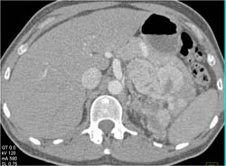 Islet Cell Tumor - CTisus CT Scan