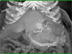 Vipoma With Vessel Invasion - CTisus CT Scan