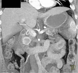 Islet Cell Tumor - CTisus CT Scan