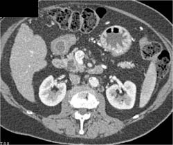 Intraductal Papillary Mucinous Neoplasm (IPMN) - CTisus CT Scan