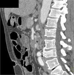 Superior Mesenteric Artery (SMA) and Superior Mesenteric Vein (SMV) Occlusion - CTisus CT Scan