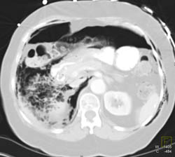 Post ERCP Perforation - CTisus CT Scan