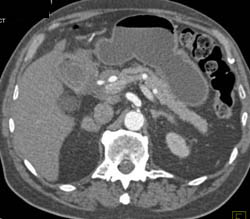 Chronic Pancreatitis - CTisus CT Scan