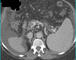 Cirrhosis With Thrombus in Portal Vein (PV), Superior Mesenteric Vein (SMV), and Splenic Vein - CTisus CT Scan