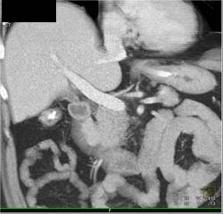 Duodenal Mass Vs Ampullary Mass; Ampullary Cancer - CTisus CT Scan