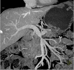 Pancreatic Cancer Encases the PV/SMV - CTisus CT Scan