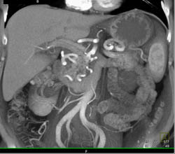 Median Arcuate Ligament Syndrome With Collaterals Through Gastroduodenal Artery (GDA)- MALS - CTisus CT Scan