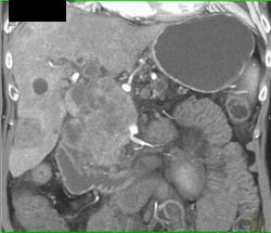 Pancreatic Cancer With Liver Metastases and Invasion of the Portal Vein With Cavernous Transformation of the Portal Vein (CTPV) - CTisus CT Scan