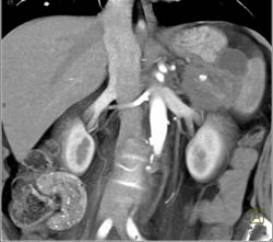 Pancreatic Cancer of the Tail of the Pancreas Invades the Spleen - CTisus CT Scan