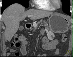 Islet Cell Tumor - CTisus CT Scan
